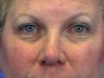 Blepharoplasty