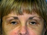 Blepharoplasty