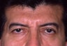 Blepharoplasty