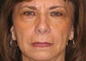 Eyelid Surgery