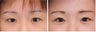 Double Eyelid Surgery - Suture Technique