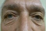 Eyelid Surgery
