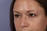 34 yr old lower eyelid surgery
