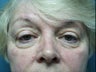 Eyelid Surgery