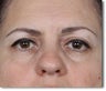 Eyelid Surgery