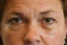 Lower blepharoplasty to improve eye bags