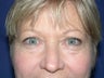 Eyelid Surgery