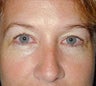 Eyelid Surgery