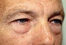 Eyelid Surgery and Brow Lift