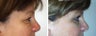 Blepharoplasty
