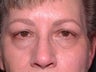 Upper blepharoplasty / Lower blepharoplasty