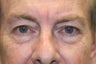 Upper blepharoplasty / Lower blepharoplasty