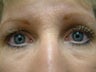 Blepharoplaty (lower eyelid fat/skin removed)