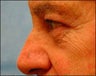 Eyelid Surgery