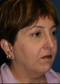 Blepharoplasty, Chin Augmentation, Browlift, Liposuction
