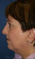 Blepharoplasty, Browlift, Liposuction, Thermage