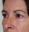 Upper & Lower Blepharoplasty