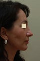 Facelift