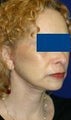 Facelift