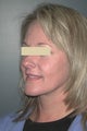 Facelift