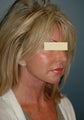 Facelift