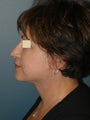 Facelift