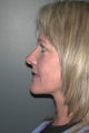 Facelift