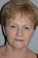 Facelift