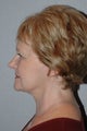 Facelift