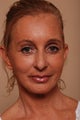Stem Cell Enriched Facial Rejuvenation