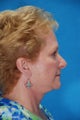 Face Lift with upper and lower blepharoplasty