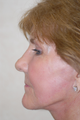 Facelift