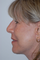 Facelift