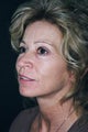 Facelift
