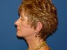 Facelift