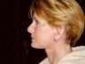 Facelift