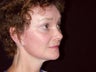 Facelift, Endoscopic Browlift, upper blephroplasty