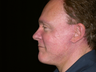 Facelift, Chin Implant, Browlift