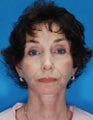 Face Lift and Chin Implant