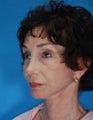 Face Lift and Chin Implant