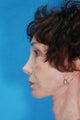 Face Lift and Chin Implant