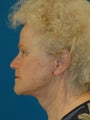 Facelift