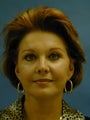 Facelift, Endoscopic Browlift, Upper and Lower Blepharoplasty