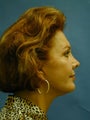 Facelift, Endoscopic Browlift, Upper and Lower Blepharoplasty
