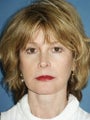 Facelift, Endoscopic Browlift, Upper and Lower Blepharoplasty, Lip Augmentation with Alloderm Grafts