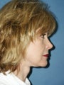 Facelift, Endoscopic Browlift, Upper and Lower Blepharoplasty, Lip Augmentation with Alloderm Grafts