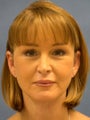 Facelift, Endoscopic Browlift, Upper and Lower Blepharoplasty, Lip Augmentation with tissue grafts, Perioral Dermabrasion