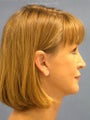 Facelift,Endoscopic Browlift, Upper and Lower Bleparoplasty, Lip Augmentation with tissue grafts, perioral dermabrasion
