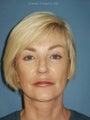 Facelift, Endoscopic Browlift, Upper and Lower Blepharoplasty, Lip Augmentation with Fat injections