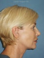 Facelift, Endoscopic Browlift, Upper and Lower Blepharoplasty, Lip Augmentation with Fat injections